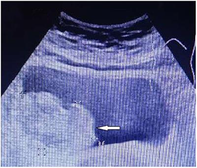 Case report: Partial cystectomy for pheochromocytoma of the urinary bladder: A case report and review of literature